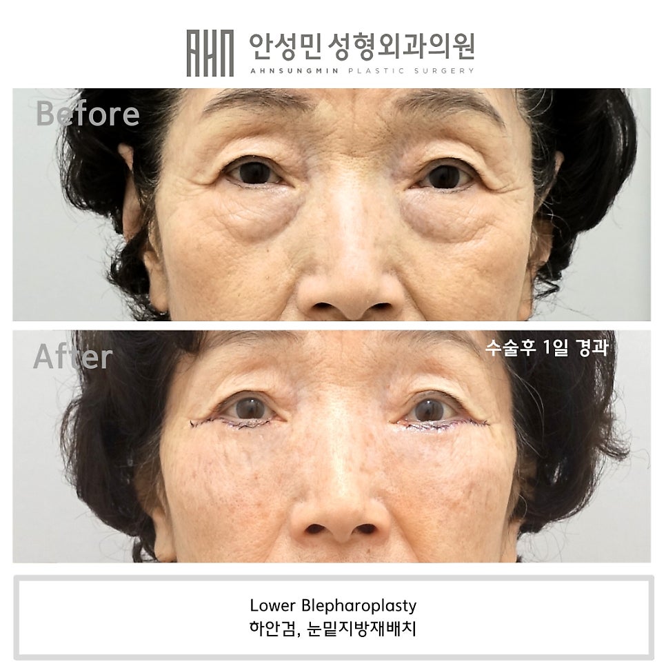 노년의 하안검 수술 주의점, 70대 여성 하안검 눈밑지방재배치 첫수술 관련 이미지 2
