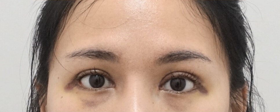 나이대별 상안검 수술 전후, 성형외과전문의 안성민 관련 이미지 8