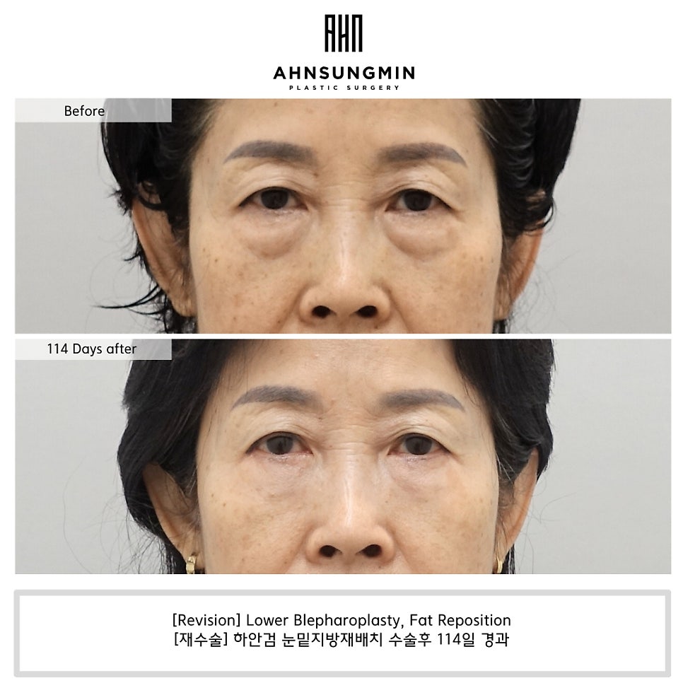 하안검 재수술 상담 [성형외과 전문의 안성민] 관련 이미지 2