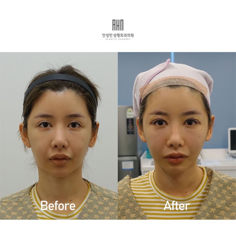 눈 재수술 관련 이미지 2