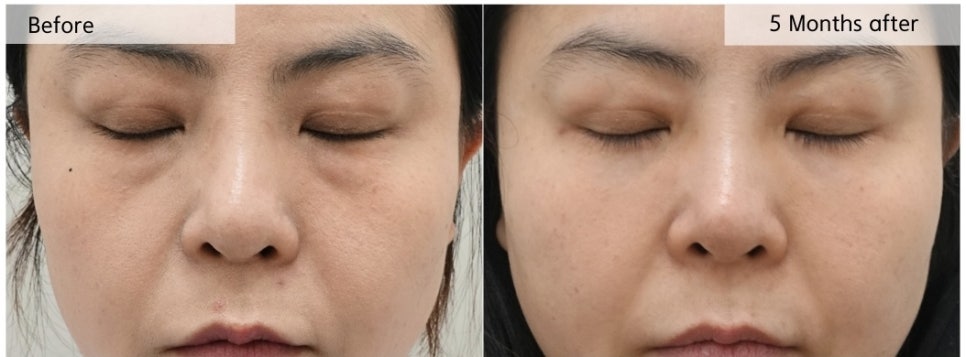 하안검 수술, 지방을 많이 제거하면 오히려 꺼질 수 있습니다 관련 이미지 2