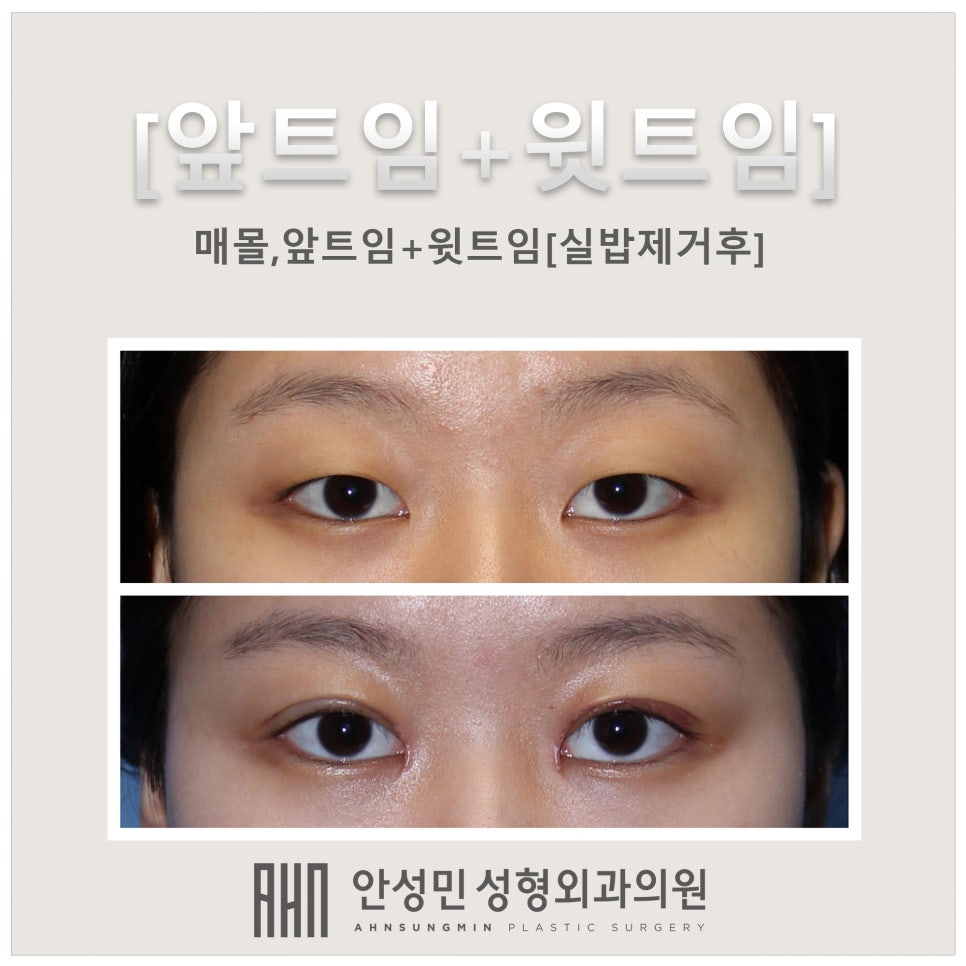 매몰법,앞트임+윗트임 관련 이미지 3