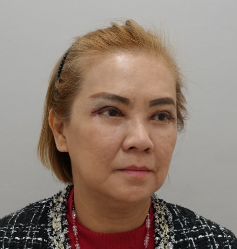 겹주름의 근본적인 원인, 눈 재수술 [성형외과 전문의 안성민] 관련 이미지 6