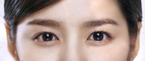 뒷트임 후 눈뜨기가 쉬워요 [성형외과 전문의 안성민] 관련 이미지 4