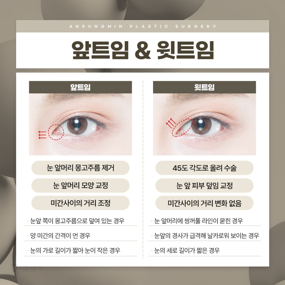 선명한 눈매는 서울트임수술 안성민 성형외과 관련 이미지 3