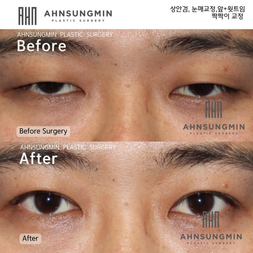 20대 남성 안검하수 눈매교정 전후 진성안검하수 관련 이미지 2