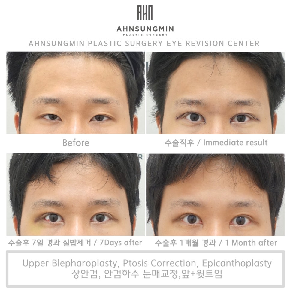 20대 남자 안검하수 수술 전후, 성형외과 전문의 관련 이미지 6