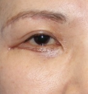 하안검 수술 성형외과 전문의가 왜 필요할까 관련 이미지 3