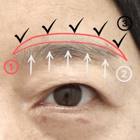 눈썹 상거상 수술이 필요한 이유와 눈썹 하거상 수술의 부작용 관련 이미지 4