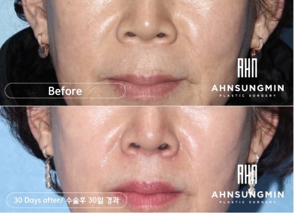 인중축소 수술이란? 관련 이미지 1