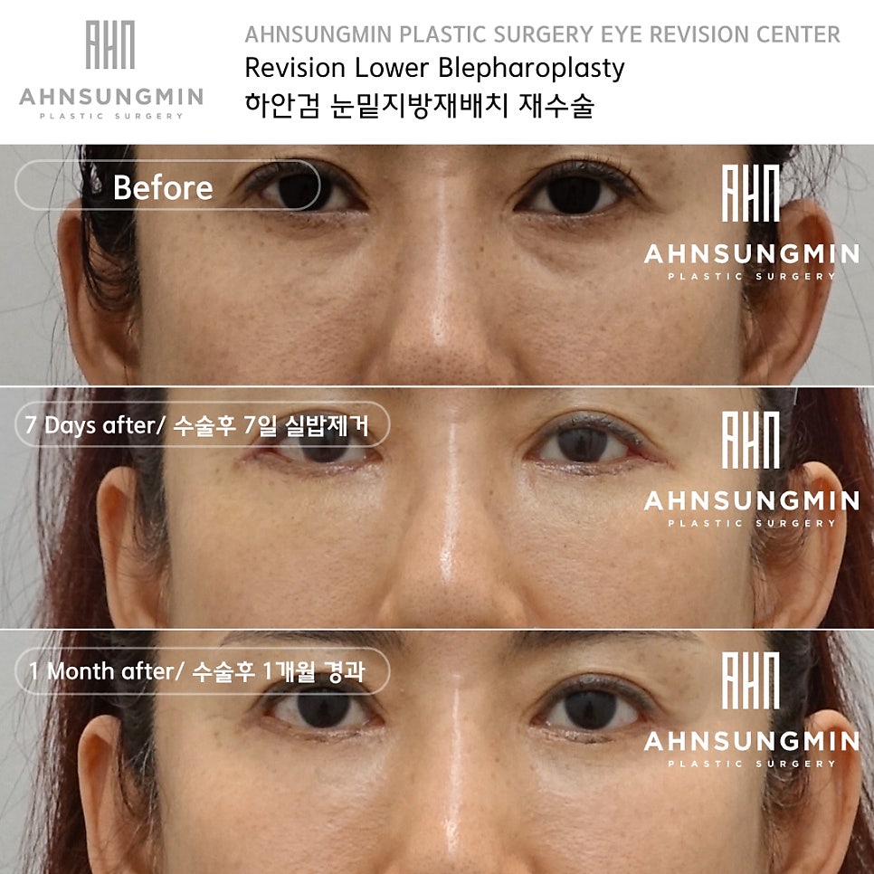 하안검 재수술 잘하려면 [성형외과 전문의 안성민] 관련 이미지 3