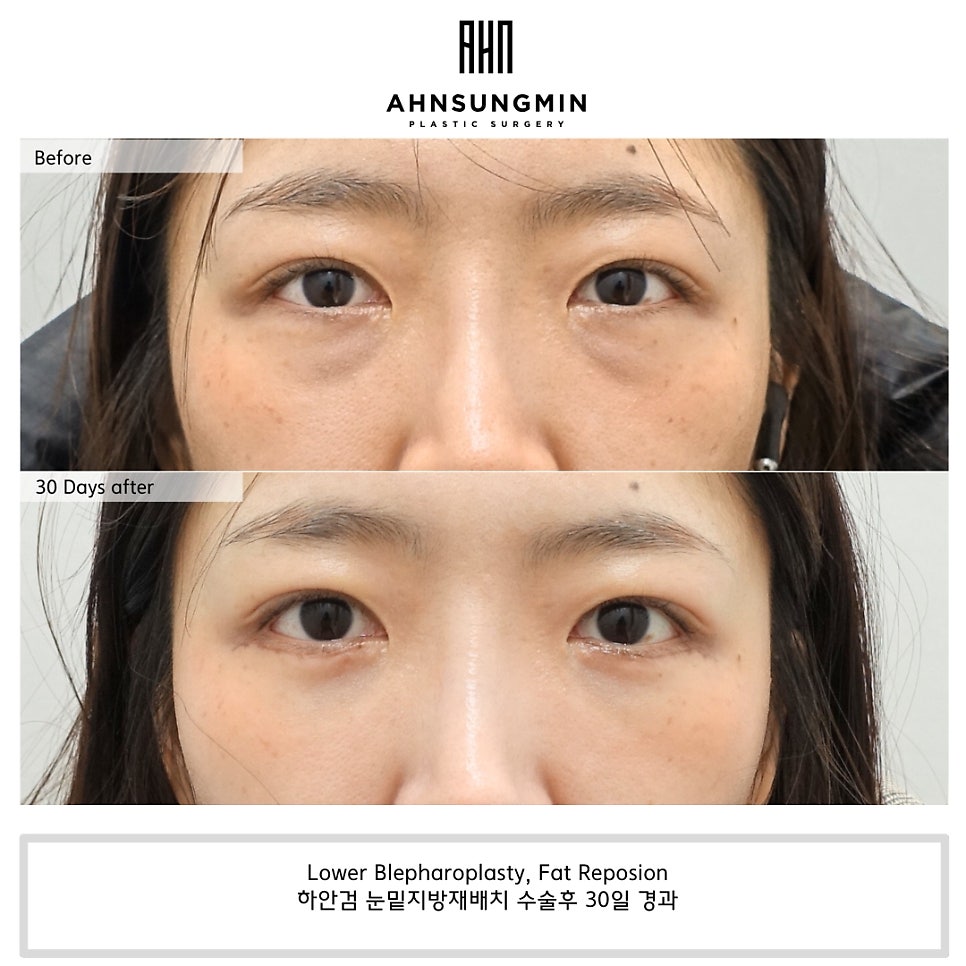 나이대별 눈 밑 수술 전후 [성형외과 전문의 안성민] 관련 이미지 2