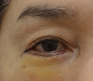 뒷트임과 하안검 수술의 공통 수술 범위. 성형외과 전문의 안성민 관련 이미지 5