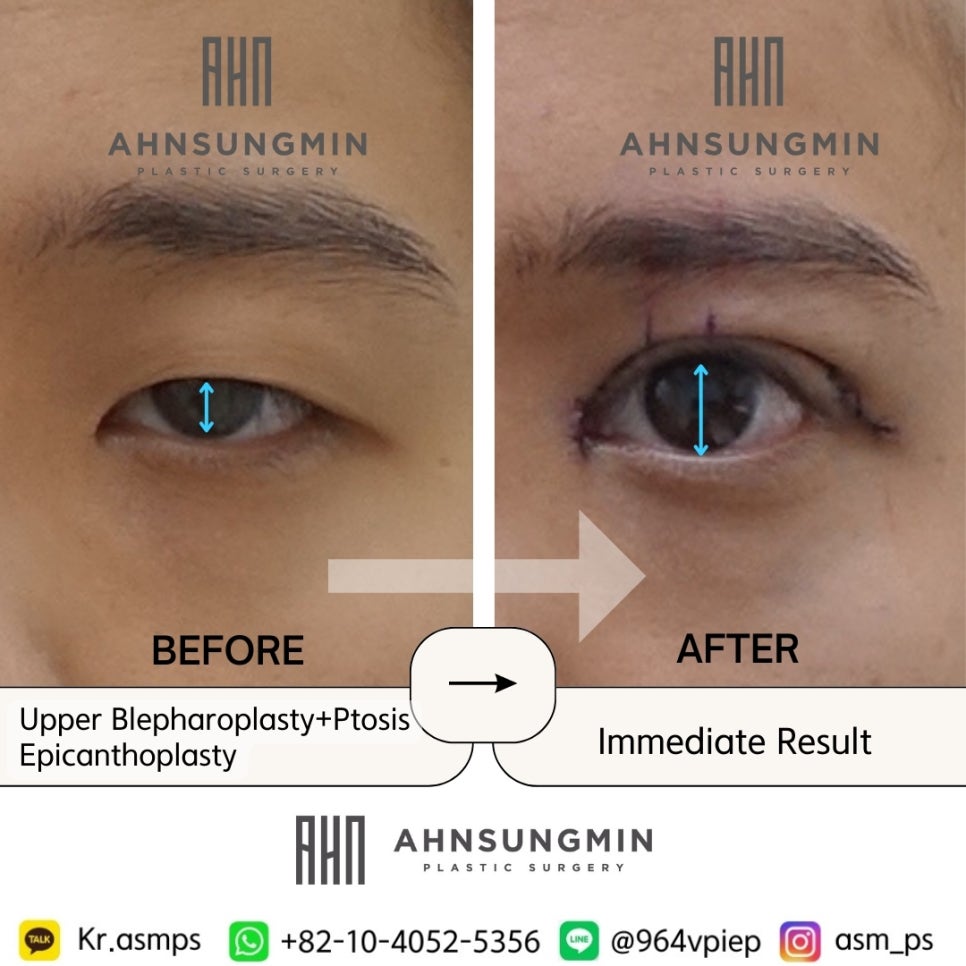 남자 안검하수 눈매교정, 20대 남자에게 어울리는 눈매교정 관련 이미지 4