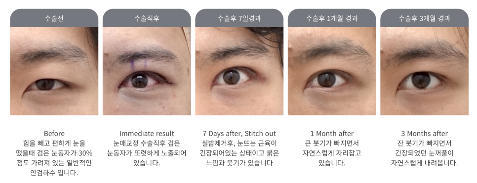 잠실새내역 성형외과 남자 안검하수 눈매교정 전문 관련 이미지 3