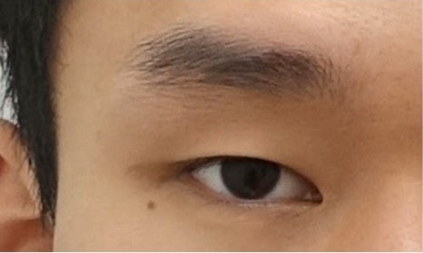 남자 눈성형 두꺼운 쌍꺼풀 풀기 관련 이미지 2