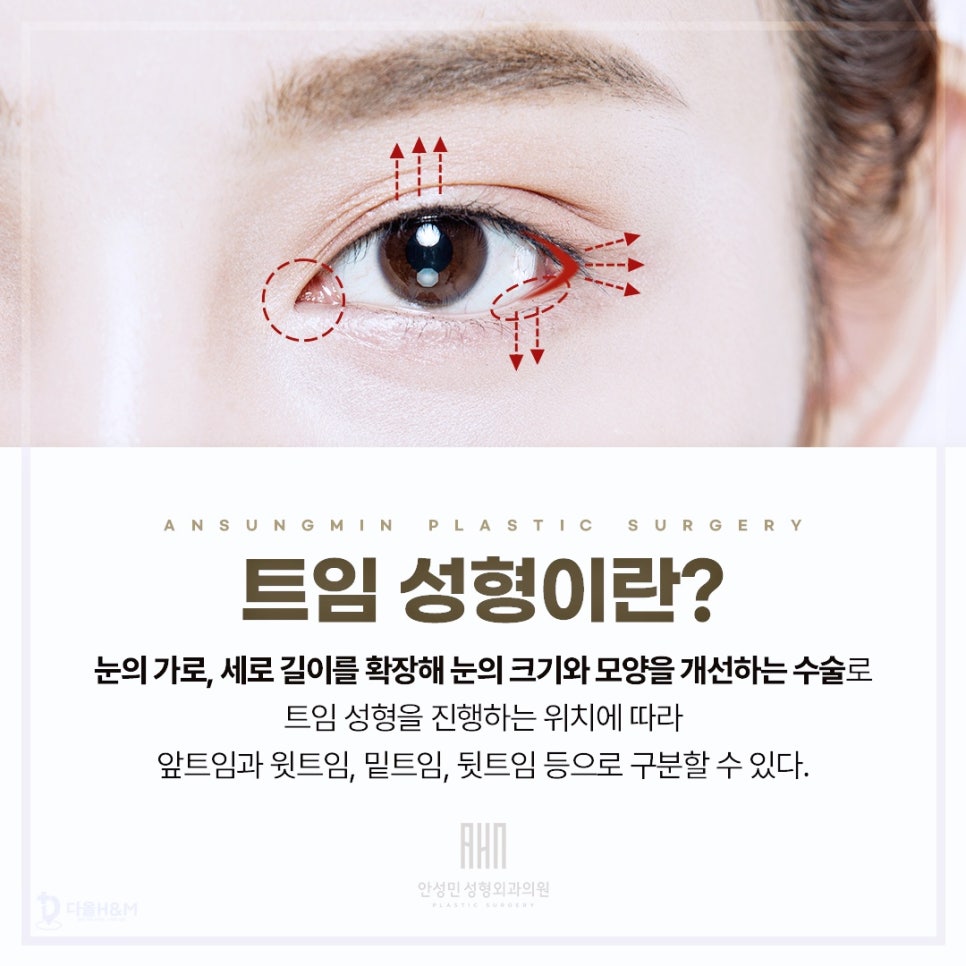 성형외과전문의 안성민이 말하는 트임수술 관련 이미지 2