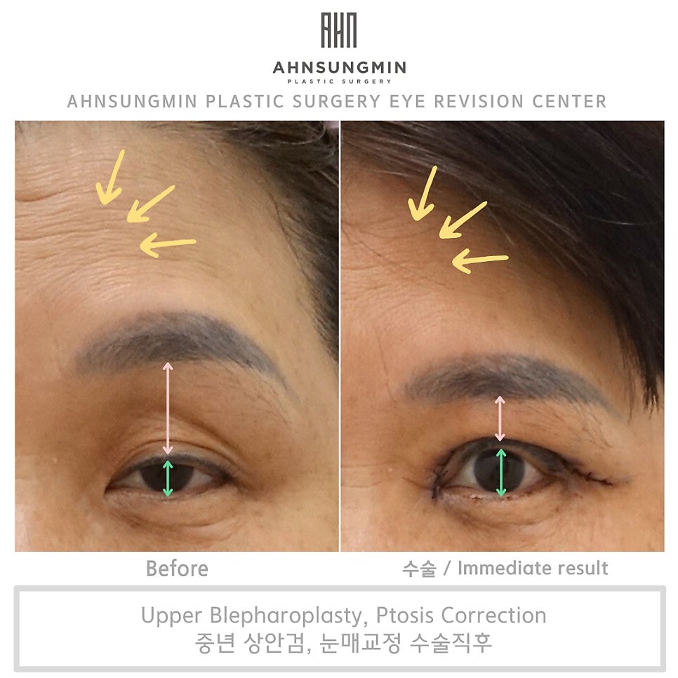 중년 여성의 상안검 수술 주의사항과 혈압관리 관련 이미지 4