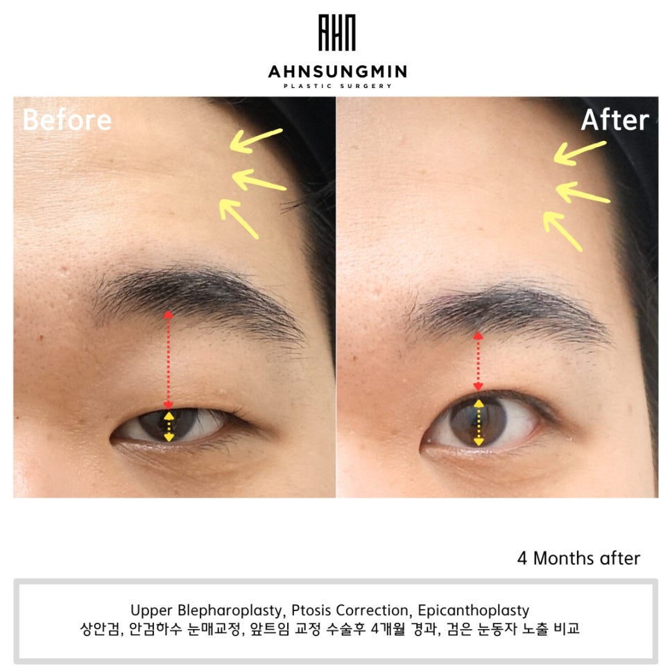 [4개월 경과] 남자 안검하수 수술의 핵심 포인트!! 관련 이미지 3