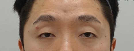 뒷트임 후 눈뜨기가 쉬워요 [성형외과 전문의 안성민] 관련 이미지 8