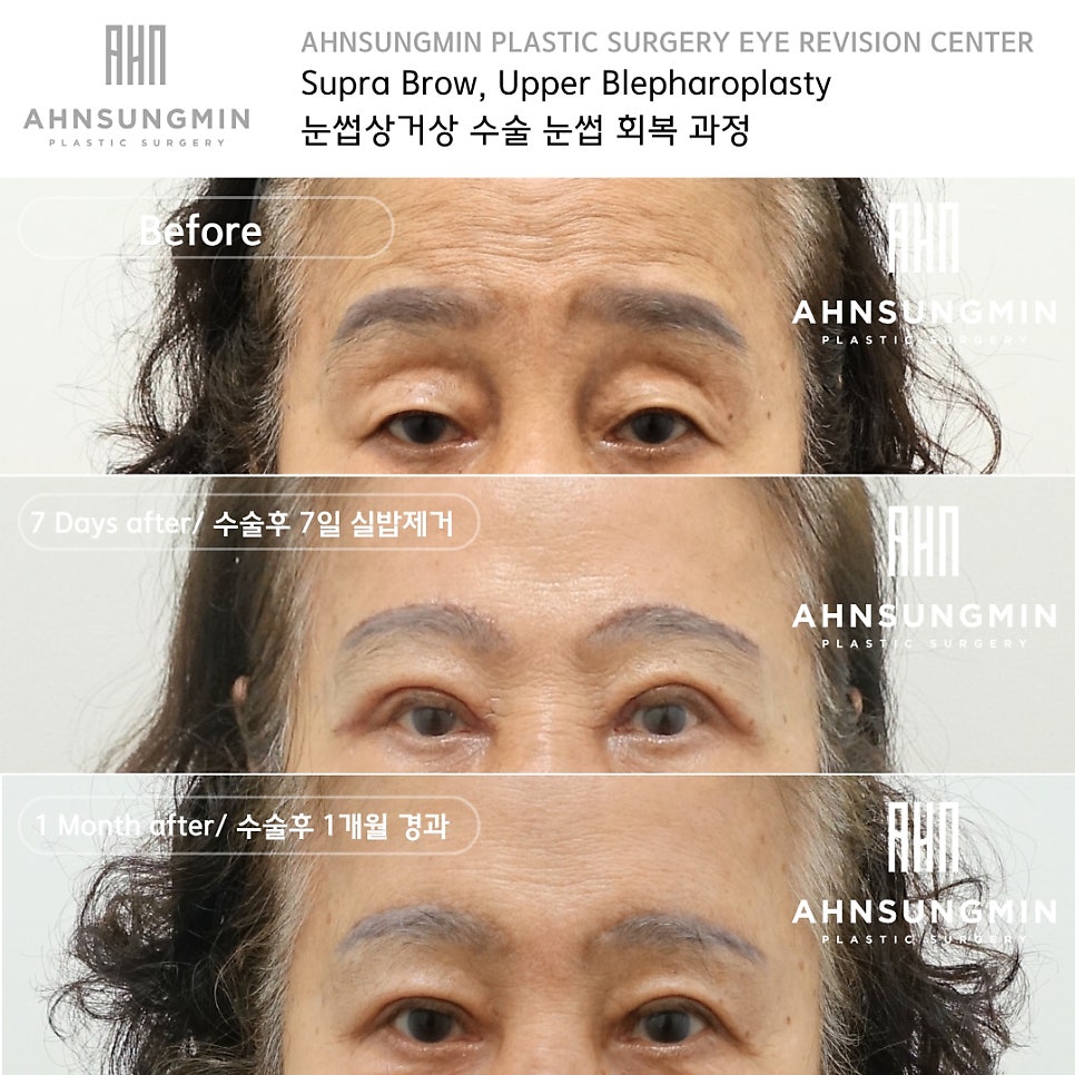눈썹거상 수술 눈썹상거상 Vs 눈썹하거상 [성형외과 전문의 안성민] 관련 이미지 5