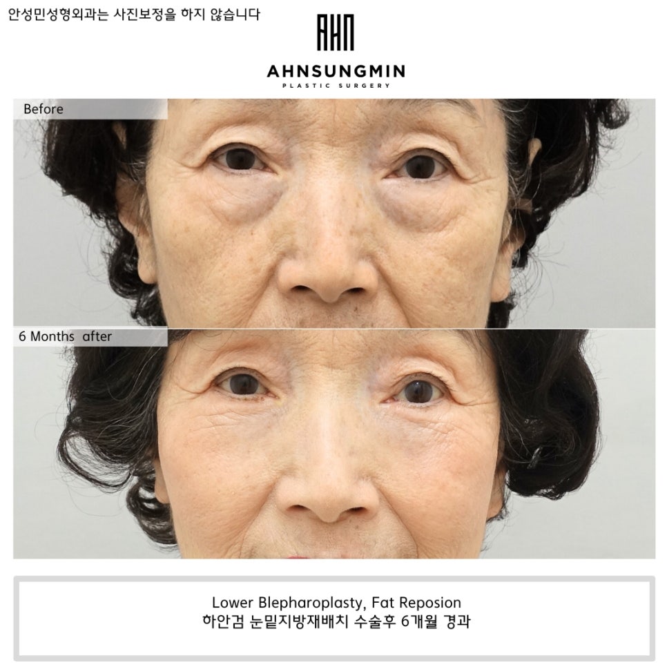 나이대별 눈밑지방재배치 수술 전후 사진 비교 관련 이미지 8