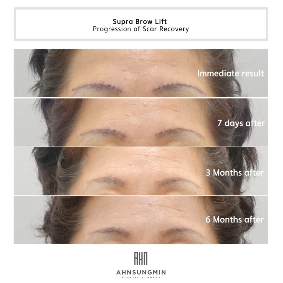눈썹 거상 수술 효과와 흉터 변화 관련 이미지 5
