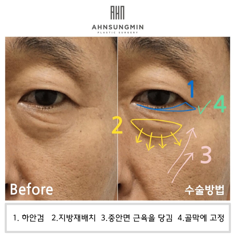 중년 남자 눈 밑 수술 후회 없이 안전하게 잘하려면 [성형외과 전문의 안성민] 관련 이미지 2