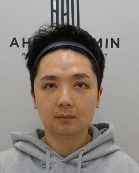 20대 남성 안검하수 증세와 눈매교정 수술 후 3개월 경과 관련 이미지 7