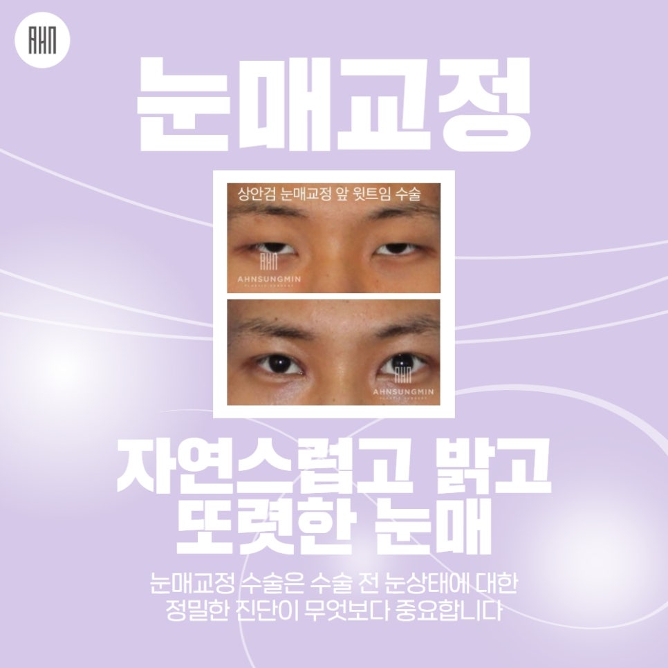 안검하수수술 또렷한 눈매를 원한다면 관련 이미지 7