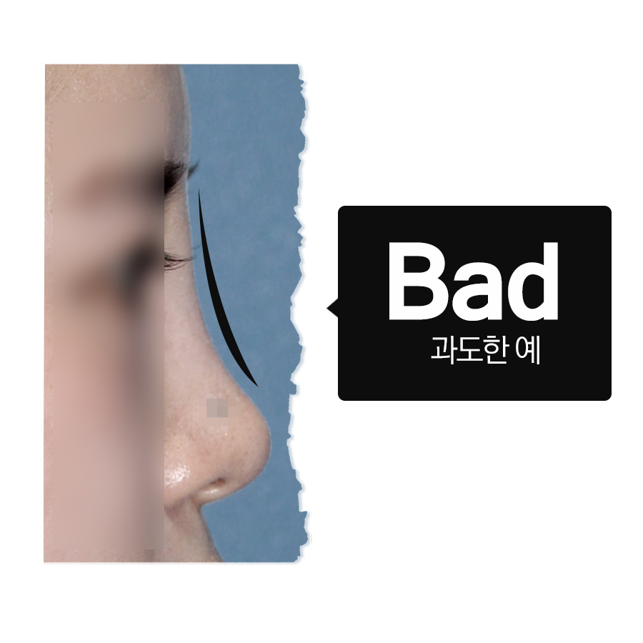 송파구 잠실동필러, 무조건 빵빵하고 높게? 관련 이미지 5