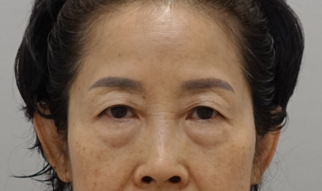 [하안검 재수술의 진실] 하안검도 재수술이 가능할까? 관련 이미지 3