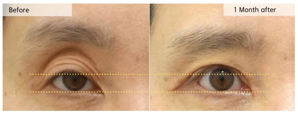 안검하수 짝짝이로 인해 눈꺼풀 꺼짐이 악화된 경우 관련 이미지 2