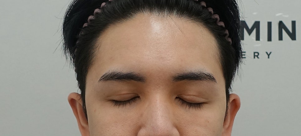 쌍꺼풀 비대칭과 비후증의 원인과 해결 방법, 성형외과 전문의 안성민 관련 이미지 3