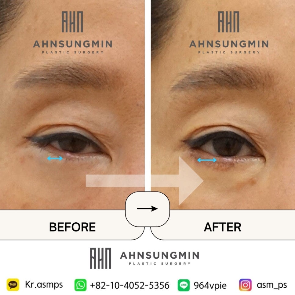 뒷트임 복원 뒷트임 재수술 시기 [뒷트임과 뒷내림] 관련 이미지 3