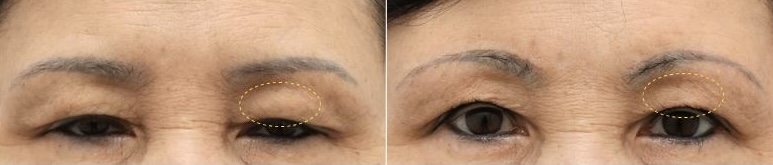 Why Did My Eyes Look More Relaxed After a Brow Lift? | Forehead Compensation and Changes in Heavy-Looking Eyes image 2