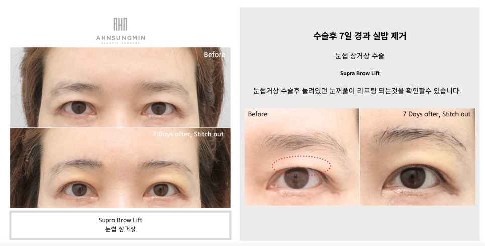 눈꺼풀 처짐의 원인과 눈썹 거상 수술이 필요한 이유 [성형외과 전문의 안성민] 관련 이미지 4