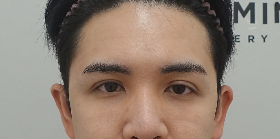 쌍꺼풀 비대칭과 비후증의 원인과 해결 방법, 성형외과 전문의 안성민 관련 이미지 2