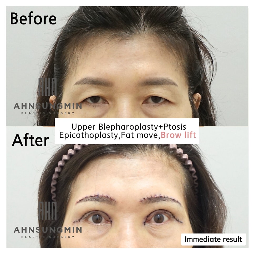 눈썹거상수술,눈썹상거상 수술이 필요한 이유 [성형외과 전문의 안성민 대표원장] 관련 이미지 4