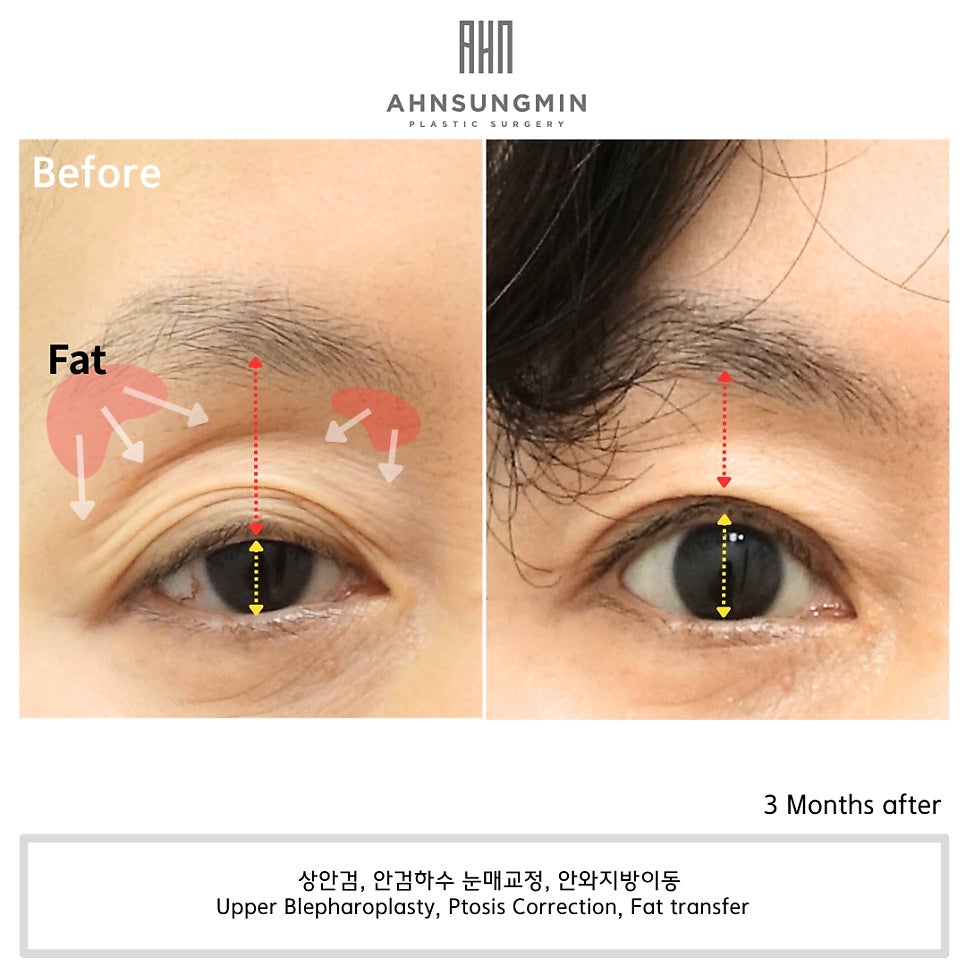 눈꺼풀 꺼짐의 원인과 해결 방법 관련 이미지 3