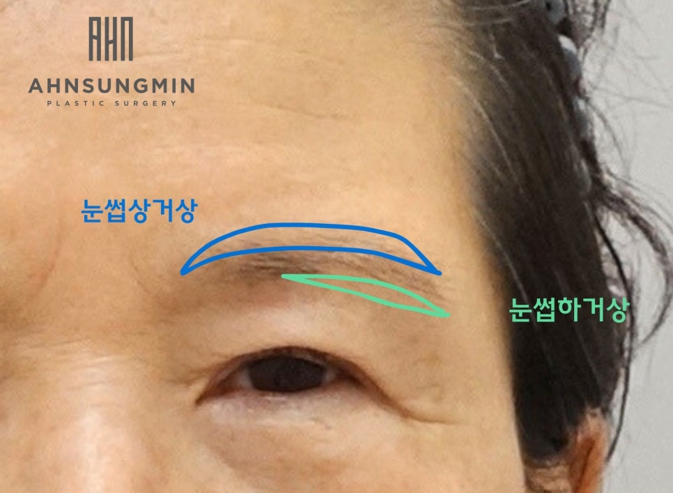 눈썹상거상이 필요한 이유 눈썹하거상의 부작용. 안성민 원장님 관련 이미지 1