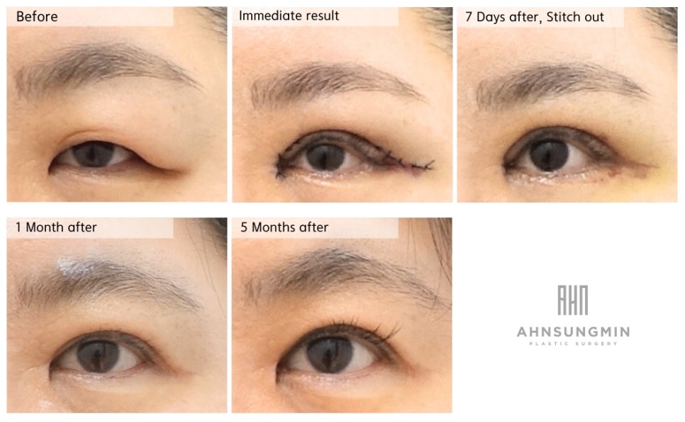 눈꺼풀이 무거울 때, 눈두덩이 지방제거 관련 이미지 3