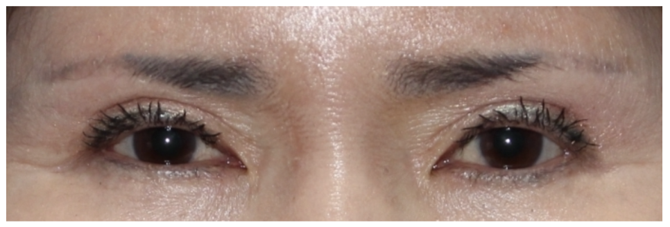 눈썹 거상 수술 효과와 흉터 변화 관련 이미지 2