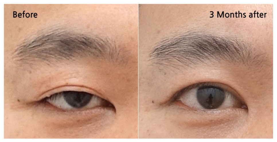 앞트임 수술이란? 내안각 교정술 Epicanthoplasty, 몽고주름 앞트임 성형술 관련 이미지 3