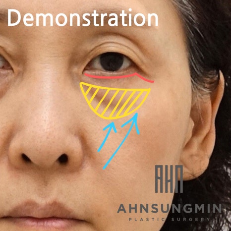 하안검 눈밑지방재배치란 무엇일까요? [지방제거를 하면 안 되는 이유] 관련 이미지 4