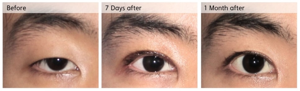 안검하수의 원인과 눈매교정 수술 전후 관련 이미지 2