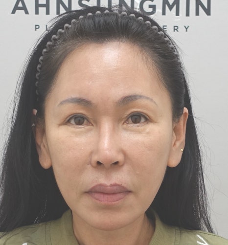 눈썹 거상 수술 후 30일 경과, 1년 경과 관련 이미지 6