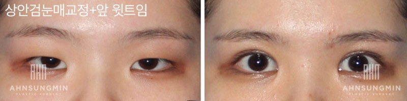 안검하수수술 또렷한 눈매를 원한다면 관련 이미지 5