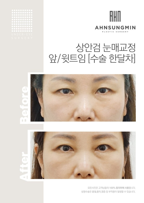 상안검눈매교정+앞윗트임 고객님입니다^^ 관련 이미지 2