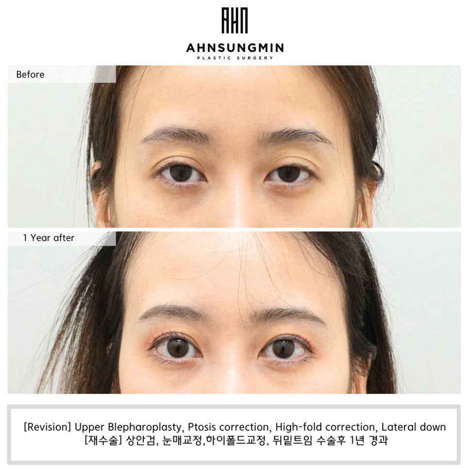 잠실새내역 성형외과 쌍꺼풀 수술의 모든 것 [안성민성형외과] 관련 이미지 3